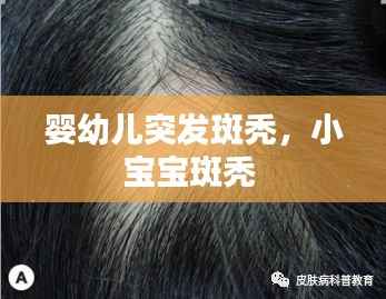 婴幼儿突发斑秃,小宝宝斑秃